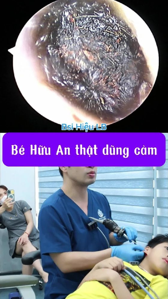 Ráy tai gây nghe kém ở trẻ em