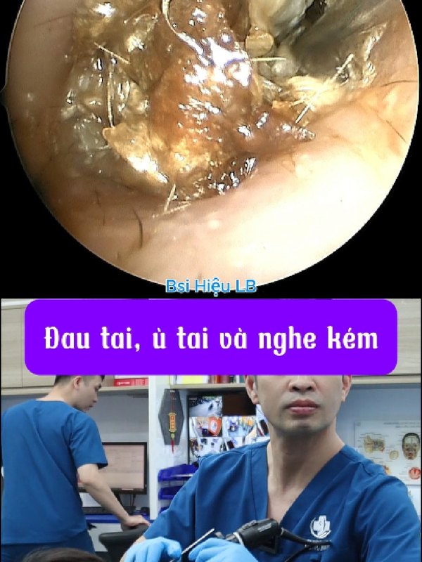 Thói quen vệ sinh sai gây nấm ống tai