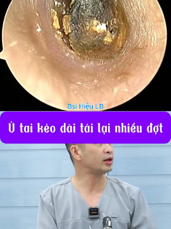 Nút ráy để lâu bịt kín ống tai