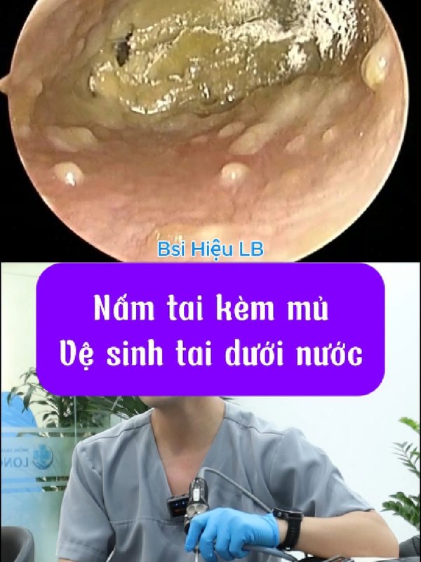 Vệ sinh tai bằng phương pháp dưới nước