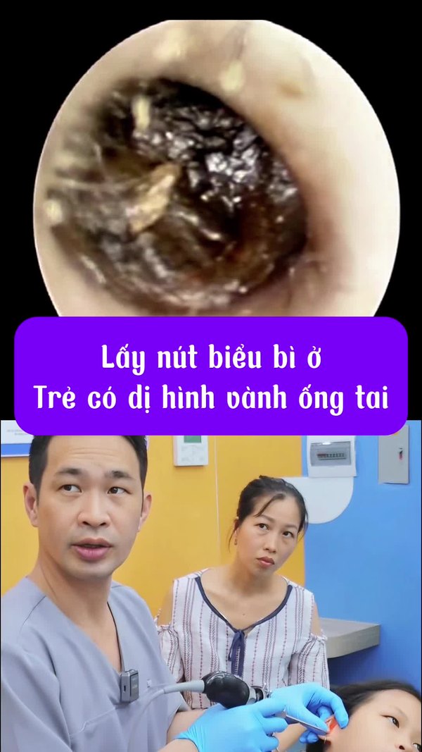 Lấy nút biểu bì — niềm vui của hai mẹ con