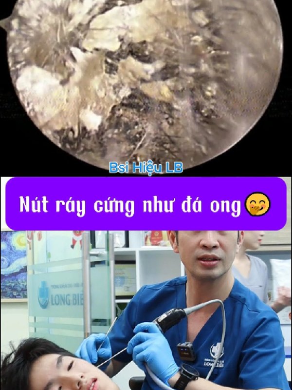 Nút ráy lớn khiến bạn nam nghe kém