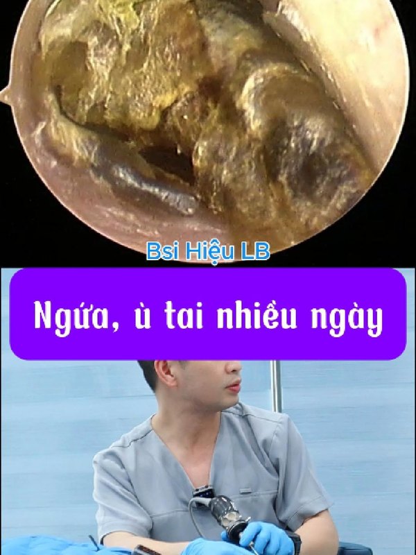 Ráy tai nhiều gây cản trở thính lực
