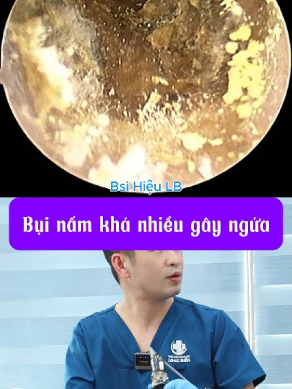 Bụi nấm gây ù và ngứa ở bạn nữ từ Điện Biên