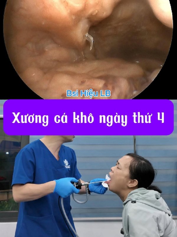 Chiếc xương mắc trong họng nhiều ngày