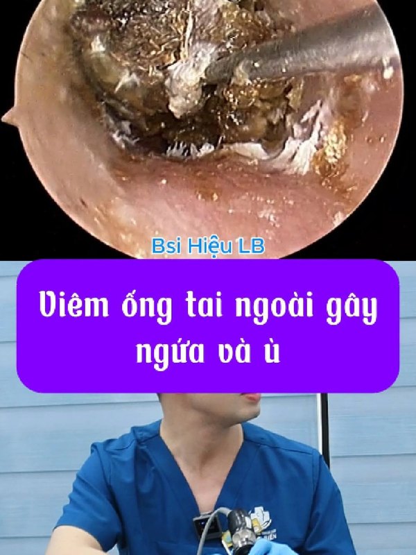Viêm ống tai ngoài gây ù và nghe kém