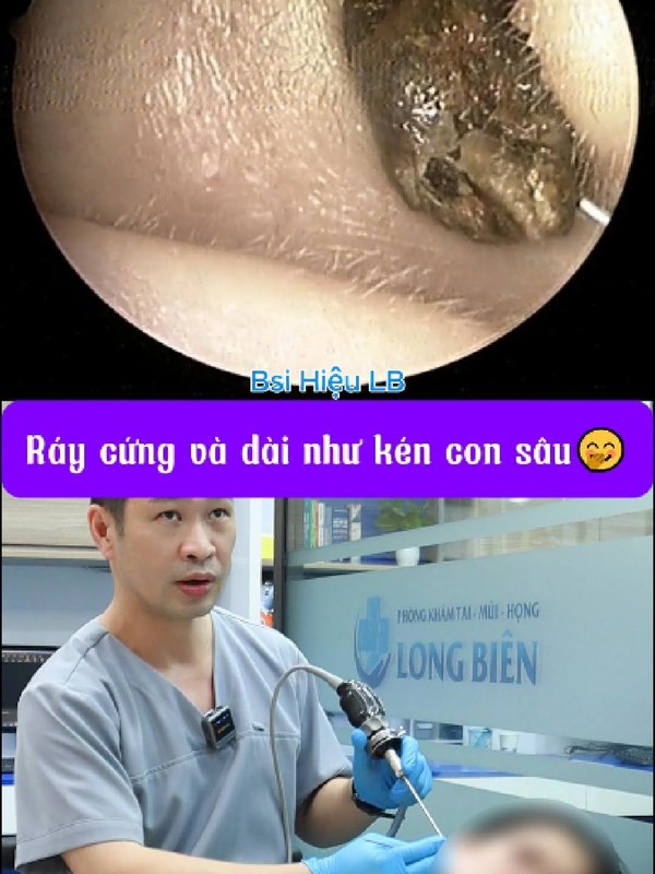 Ráy tai cứng và dài như kén con sâu