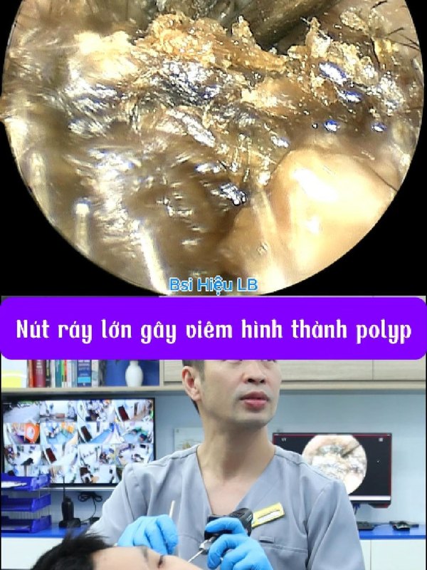 Để lâu không vệ sinh gây viêm tai