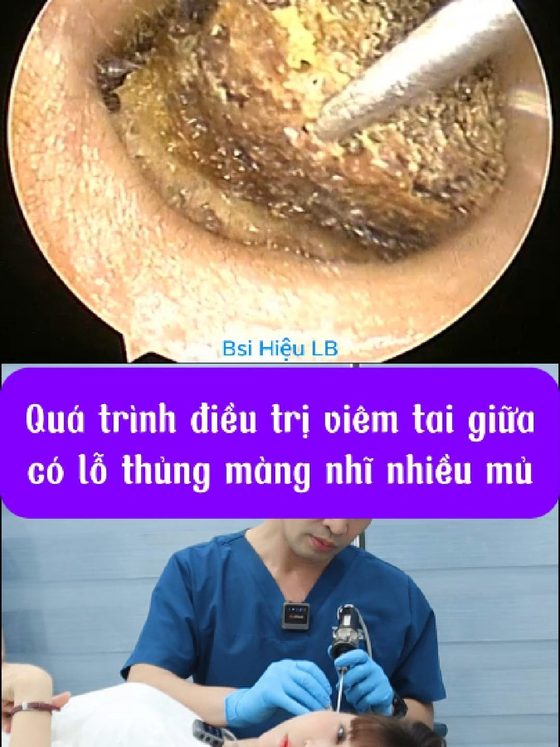 Điều trị viêm tai giữa & vá màng nhĩ