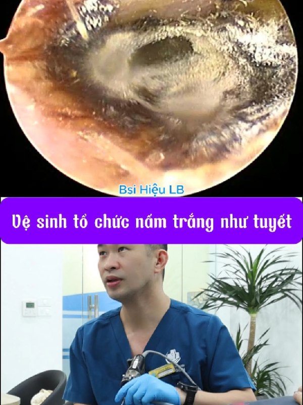 Vệ sinh tai đúng cách để tránh nhiễm nấm