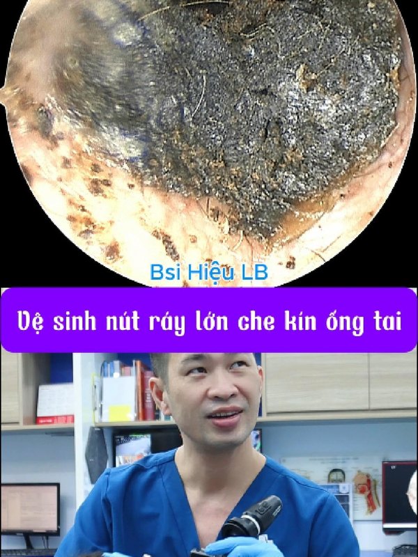 Nút ráy tai có hình dáng khá lạ