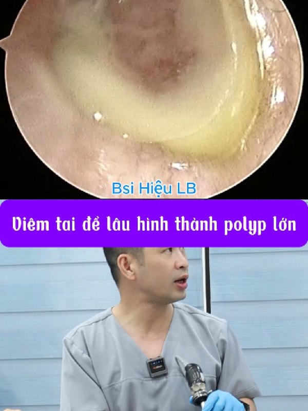 Viêm tai tái lại nhiều lần hình thành polyp