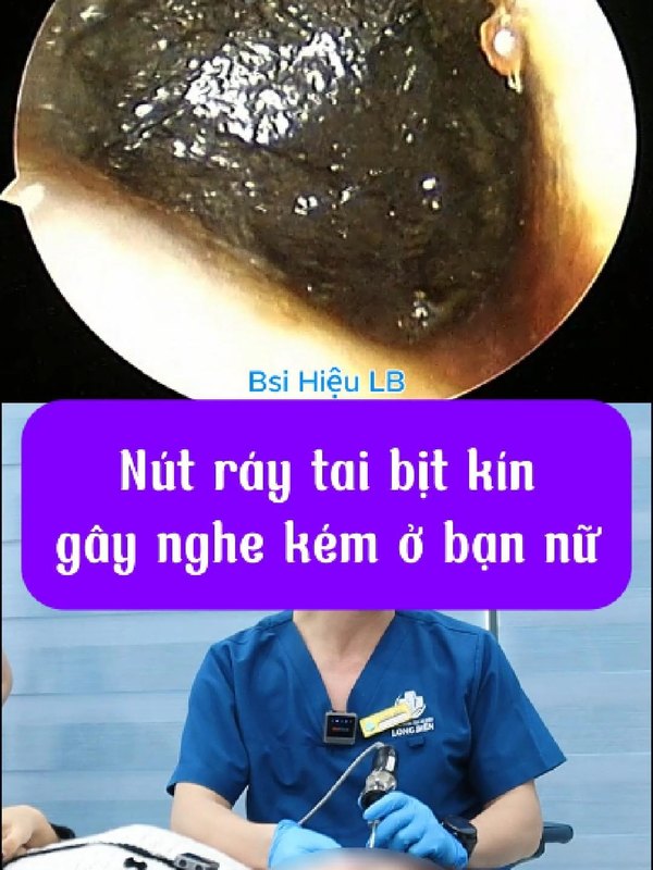 Vệ sinh nút ráy tai lớn để lâu