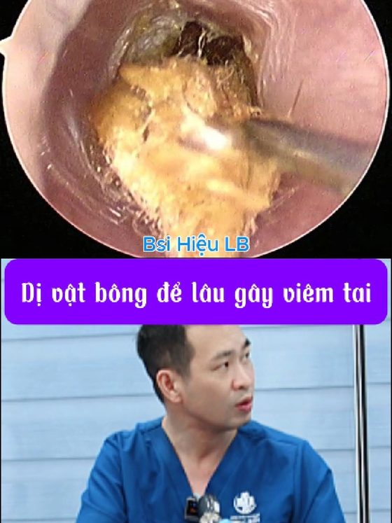 Để bông trong tai quá lâu gây viêm