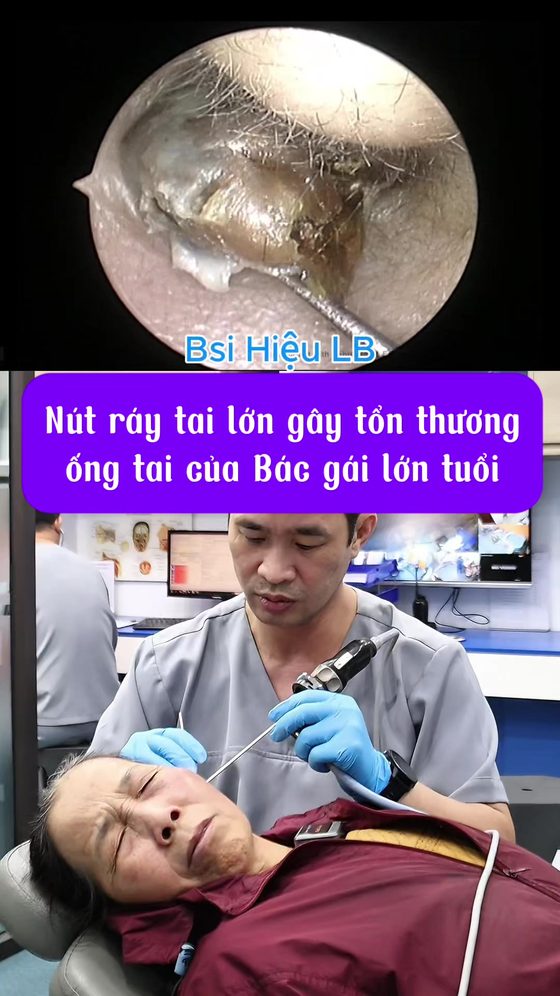 Đau tai kéo dài do nút ráy tai lớn