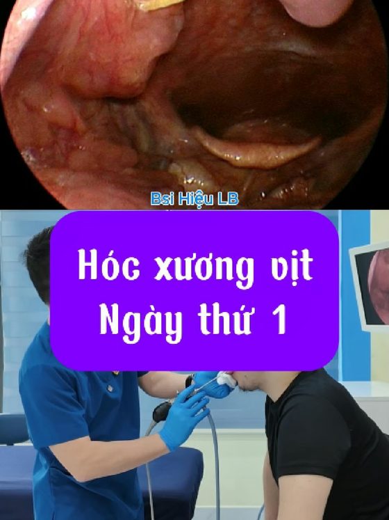 Gắp hóc xương vịt cho bệnh nhân