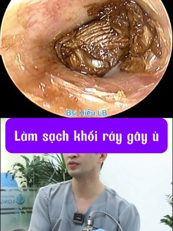 Ù tai do ráy tai