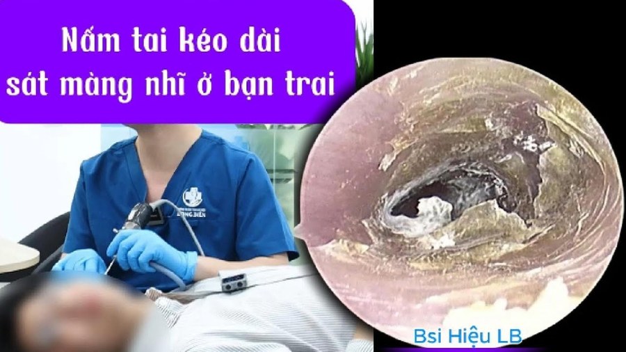 Nấm tai kéo dài sát màng nhĩ