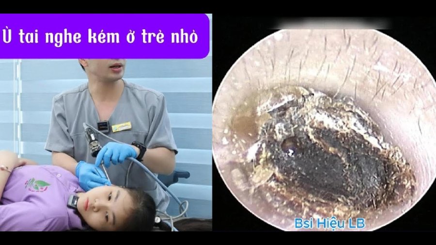 Ù tai nghe kém ở trẻ nhỏ