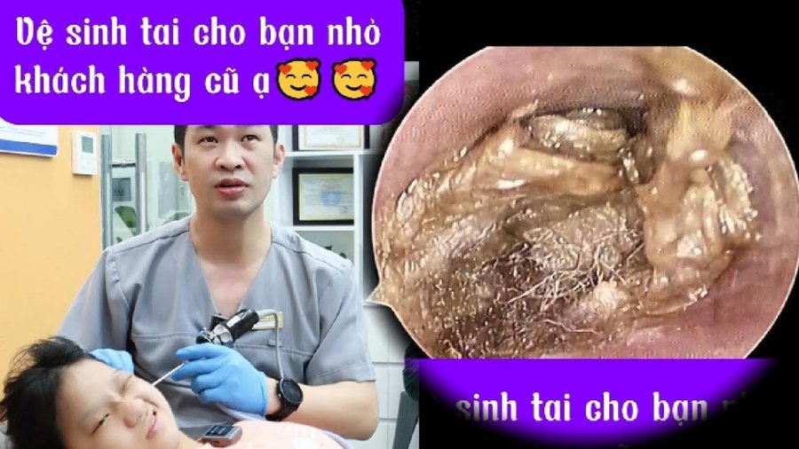 Ráy tai quá nhiều gây ù và đau tai