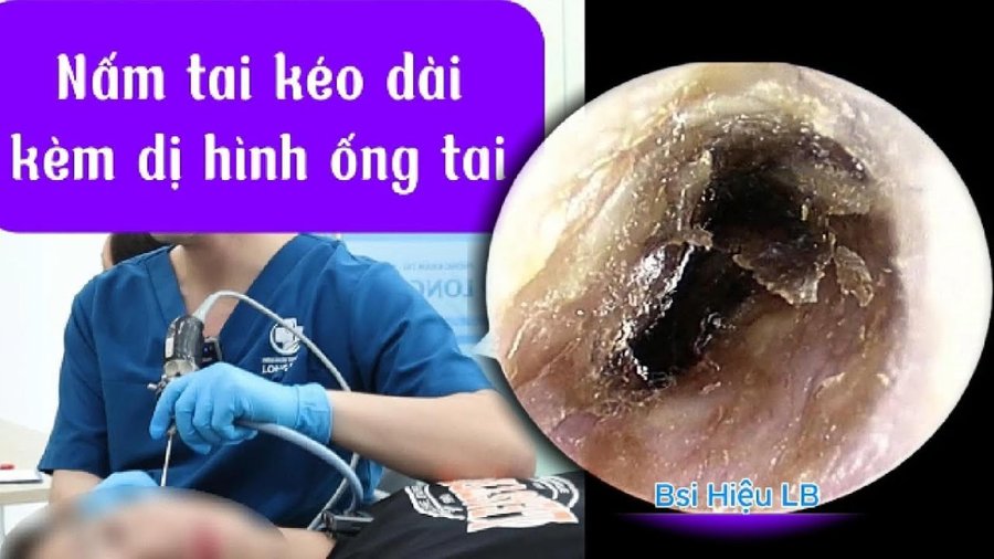 Nấm tai kéo dài kèm dị hình ống tai
