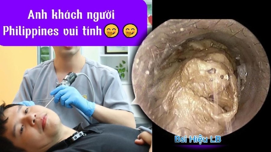 Nút ráy tai của anh khách người Philippines